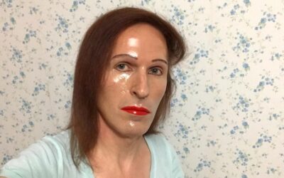 Jak zlikwidować popękane naczynka krwionośne na twarzy?